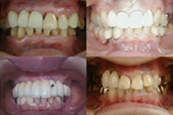 セーフティアップ・インプラントテクニックセミナー | DentalMovie 歯科医師向け映像教材配信 セーフティアップ・インプラントテクニックセミナー | DentalMovie 歯科医師向け映像教材配信